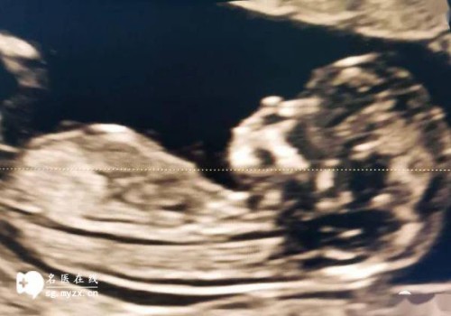 成都助孕中心：生孩子后更容易患恶性子宫肌瘤吗？